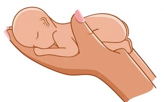 Nacimiento Prematuro